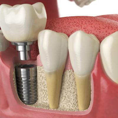 7 semne că ai nevoie de un implant dentar și nu de o punte