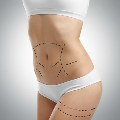 Lipoaspiratia, ca metoda de modelare a conturului corporal