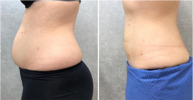 Lipoaspirația asistată laser: Inovație în estetica corporală, cu rezultate permanente