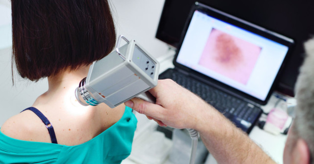 Formula ABCDE pentru a depista alunițele periculoase