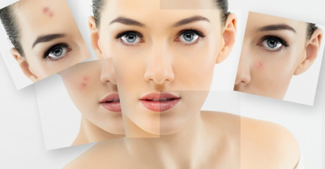 Peeling chimic