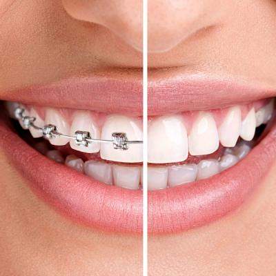 Aparatul dentar – influenta asupra simetriei faciale