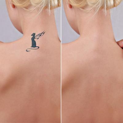 Vrei sa iti stergi tatuajul? Iata ce trebuie sa stii