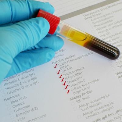 Proteina C reactiva: ce este si ce ne indica valorile sale despre sanatatea organismului