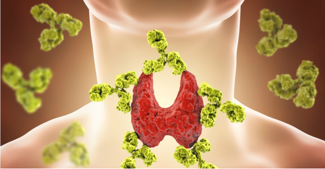 Tiroidita autoimuna, rezultatul unei functionari defectuoase a sistemului imunitar. Simptome, cauze, tratament