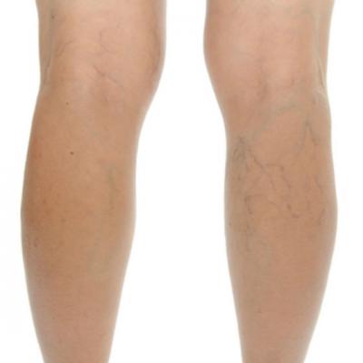 Ozokerite pentru recenzii ale artrozei genunchiului