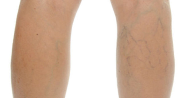5 Tratamente naturiste pentru VARICE