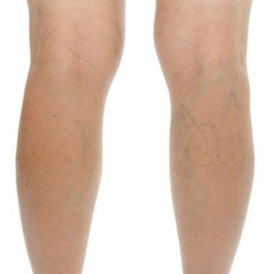 5 Tratamente naturiste pentru VARICE