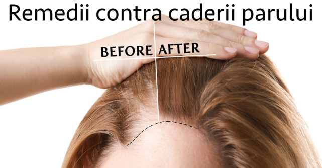 5 Remedii contra căderii părului