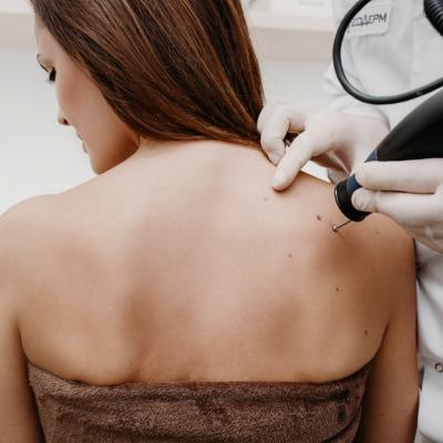 De ce nu este recomandat sa indepartam negii si papiloamele cutanate la domiciliu