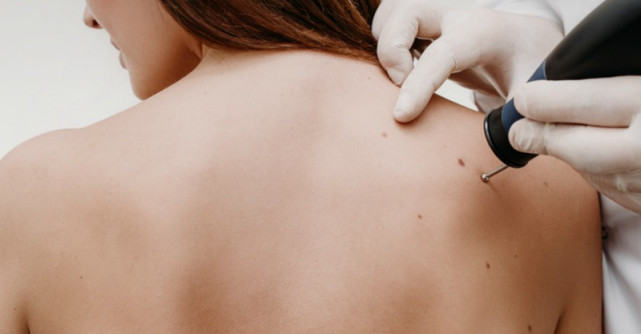 De ce nu este recomandat sa indepartam negii si papiloamele cutanate la domiciliu