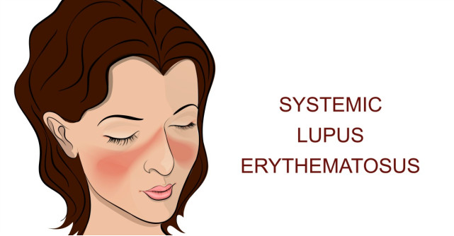 Lupus, boala autoimuna cronica ce poate afecta orice parte a corpului