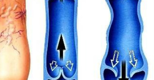 Sportul poate provoca varice - afla ce trebuie sa eviti