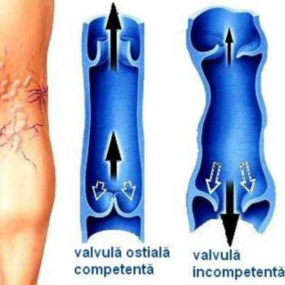Sportul poate provoca varice - afla ce trebuie sa eviti