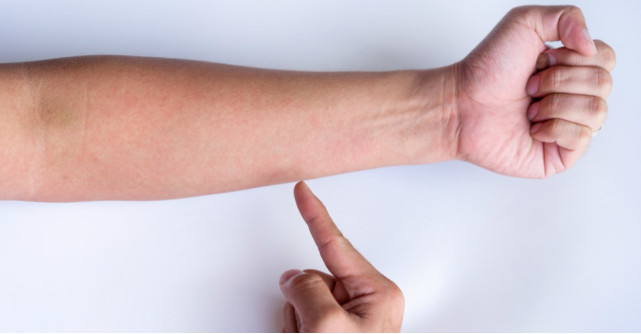 Vasculita, boala autoimuna care afecteaza vasele de sange. Simptome, cauze si tratament