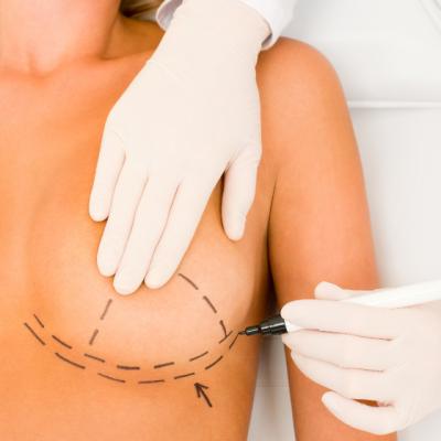 Mitul implanturilor mamare: rotunde sau anatomice, afla care ti se potrivesc!