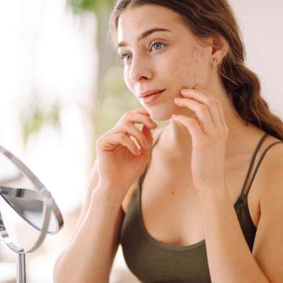 De ce nu dispar semnele post-acneice încăpățânate și cum le putem trata eficient