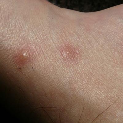 Cum sa scapi de foliculita