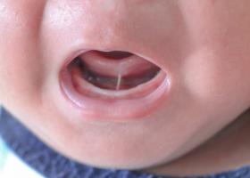 Frenul scurt sublingual (anchiloglosie) la bebeluși și copii - diagnostic, tratament