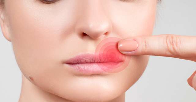 Herpes oral la adulți – tratament, prevenție și remedii