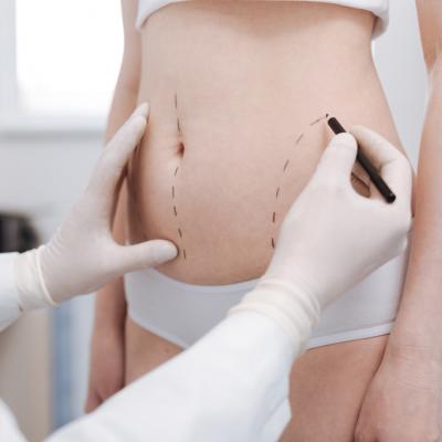 Lipoaspirația, soluția care-ți garantează minus 10 cm în talie