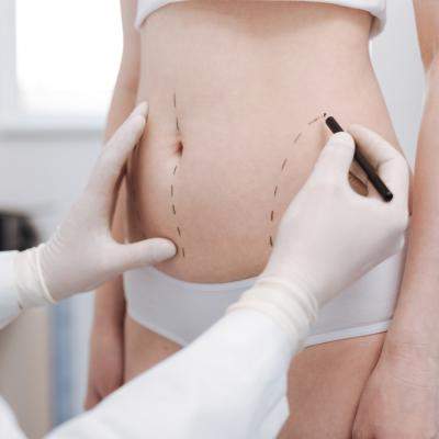 Lipoaspirația, soluția care-ți garantează minus 10 cm în talie