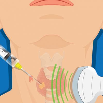 Tot ce trebuie să știi despre biopsii: beneficii, recomandări și tehnici de realizare