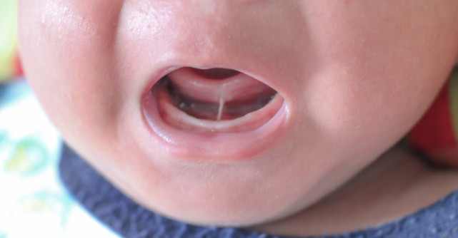 Frenul scurt sublingual (anchiloglosie) la bebeluși și copii