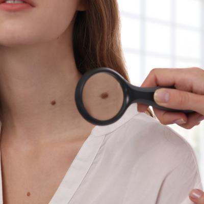 Când ar trebui să te îngrijoreze o aluniță? Semnale de alarmă pe care nu trebuie să le ignori