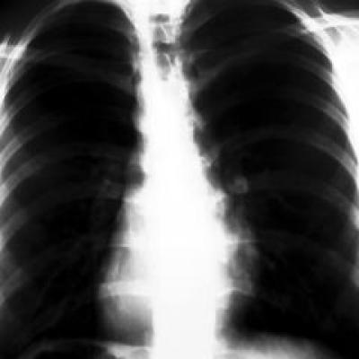 TBC - Sa luptam impreuna pentru combaterea acestei boli