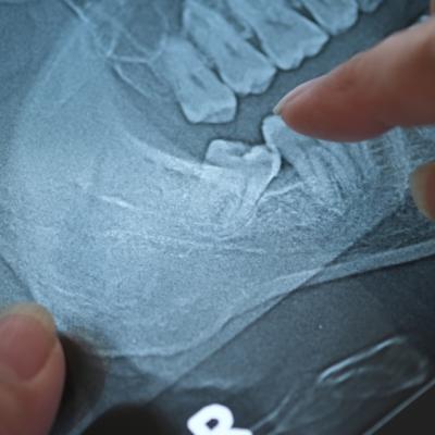 Măselele de minte sunt o mină de „aur” ascunsă în cavitatea bucală. Cum pot celulele stem din ele vindeca boli grave?