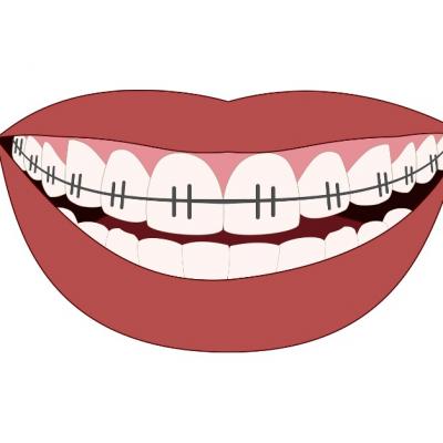 Ce facem daca purtam aparat dentar in perioada de izolare la domiciliu?