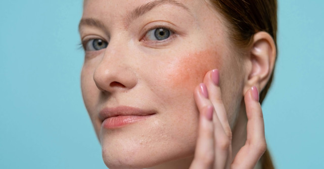 Sfaturi de machiaj pentru tenul cu rozacee: cum să-ți evidenţiezi frumusețea naturală