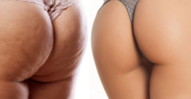 Aceste 3 alimente DISTRUG celulita