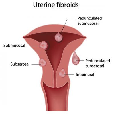 FIBROMUL uterin: Histerectomie, Miomectomie sau Embolizare?