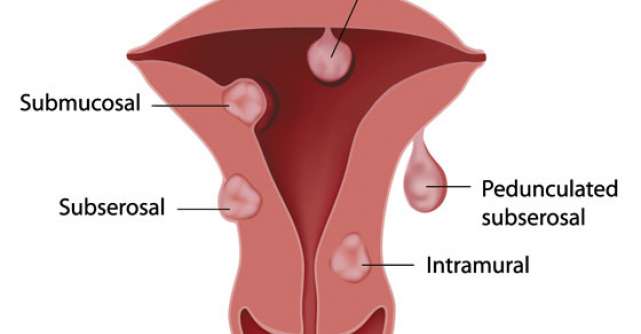 FIBROMUL uterin: Histerectomie, Miomectomie sau Embolizare?