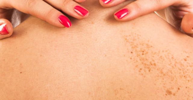 Scapi de PETELE MARONII de pe piele cu aceasta RETETA