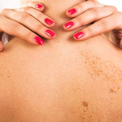 Scapi de PETELE MARONII de pe piele cu aceasta RETETA