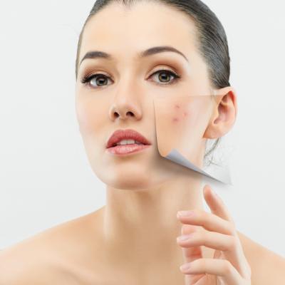 7 Tratamente BIO impotriva ACNEEI