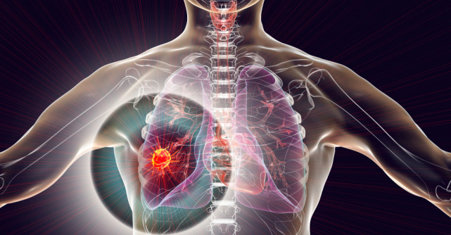 Cancerul pulmonar: ce ar trebui să știm și de ce este important să fim informați