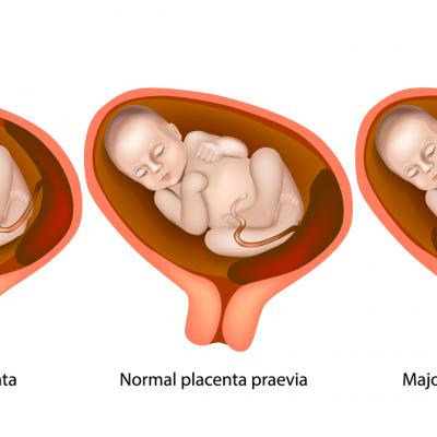 Placenta Praevia: ce înseamnă, cauze, simptome și tratament