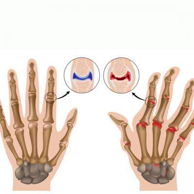 Poliartrita reumatoida, cea mai frecventa boala articulara de tip inflamator