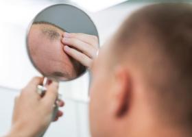 Pas cu pas. Cum este efectuat un implant de păr la o clinică specializată