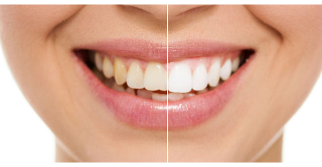 Video: Cum sa iti albesti dintii cu doar doua ingrediente? Tratamentul pe care il poti face acasa