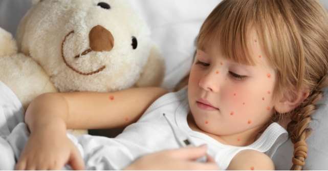 Tot ce trebuie sa stii despre varicela, infectia virala care provoaca febra si eruptie cutanata pe tot corpul