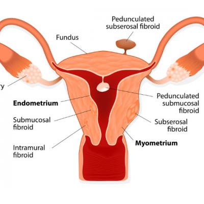 Fibromul uterin - ce ar trebui sa stie o femeie