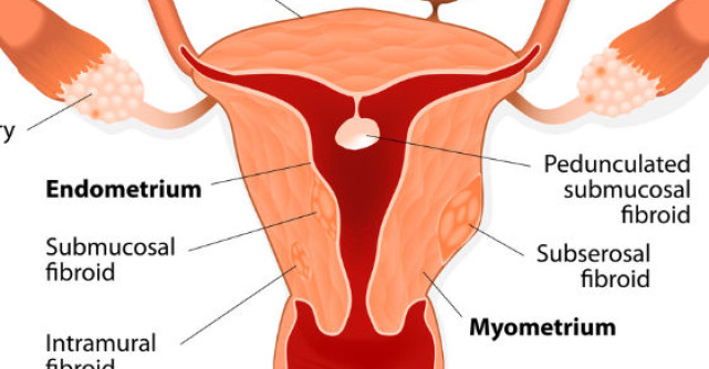 Fibromul uterin - ce ar trebui sa stie o femeie