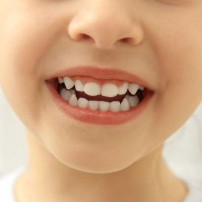 Cariile copiilor: de ce se tratează dacă tot sunt dinți de lapte și îi schimbă?