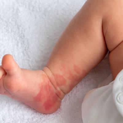 Pete roșii la nou-născuți: când să te îngrijorezi? 