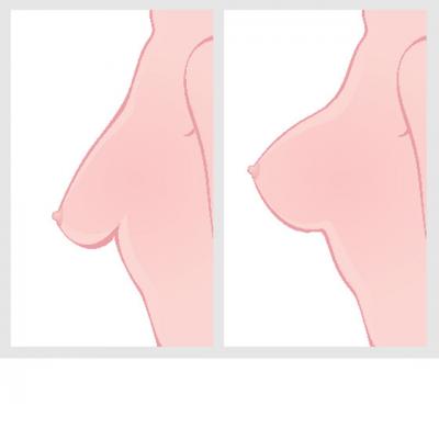 Liftingul mamar: pariu cu timpul si gravitatia